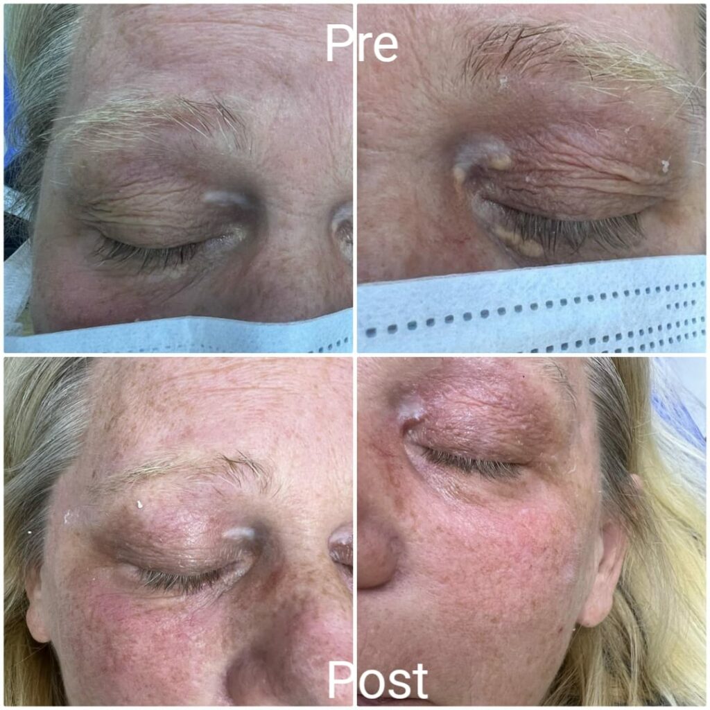 ازالة رواسب الكوليسترول حول العين